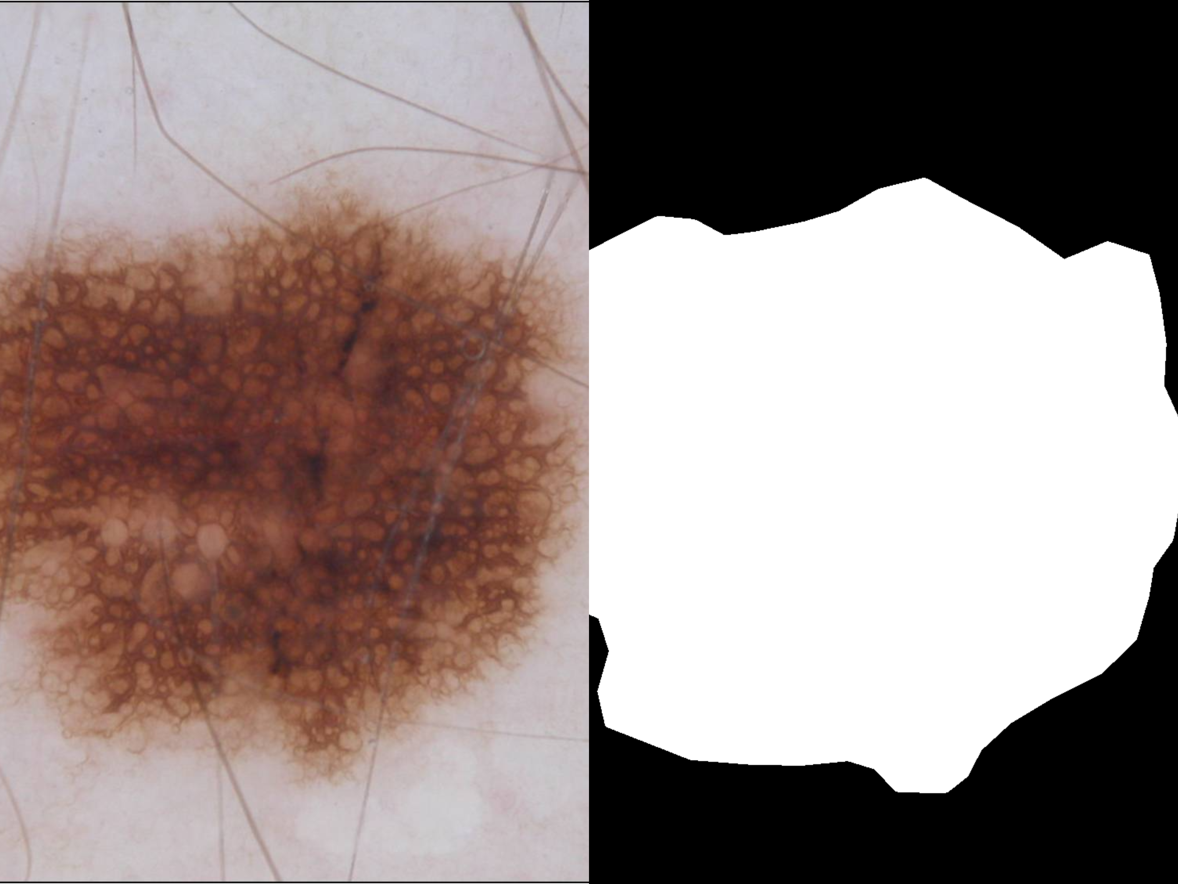 Skin Lesion Segmentation